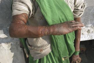 Mitgifttrauma – der vernarbte Arm einer Frau, die von ihren Schwiegereltern in Brand gesetzt wurde und überlebte.