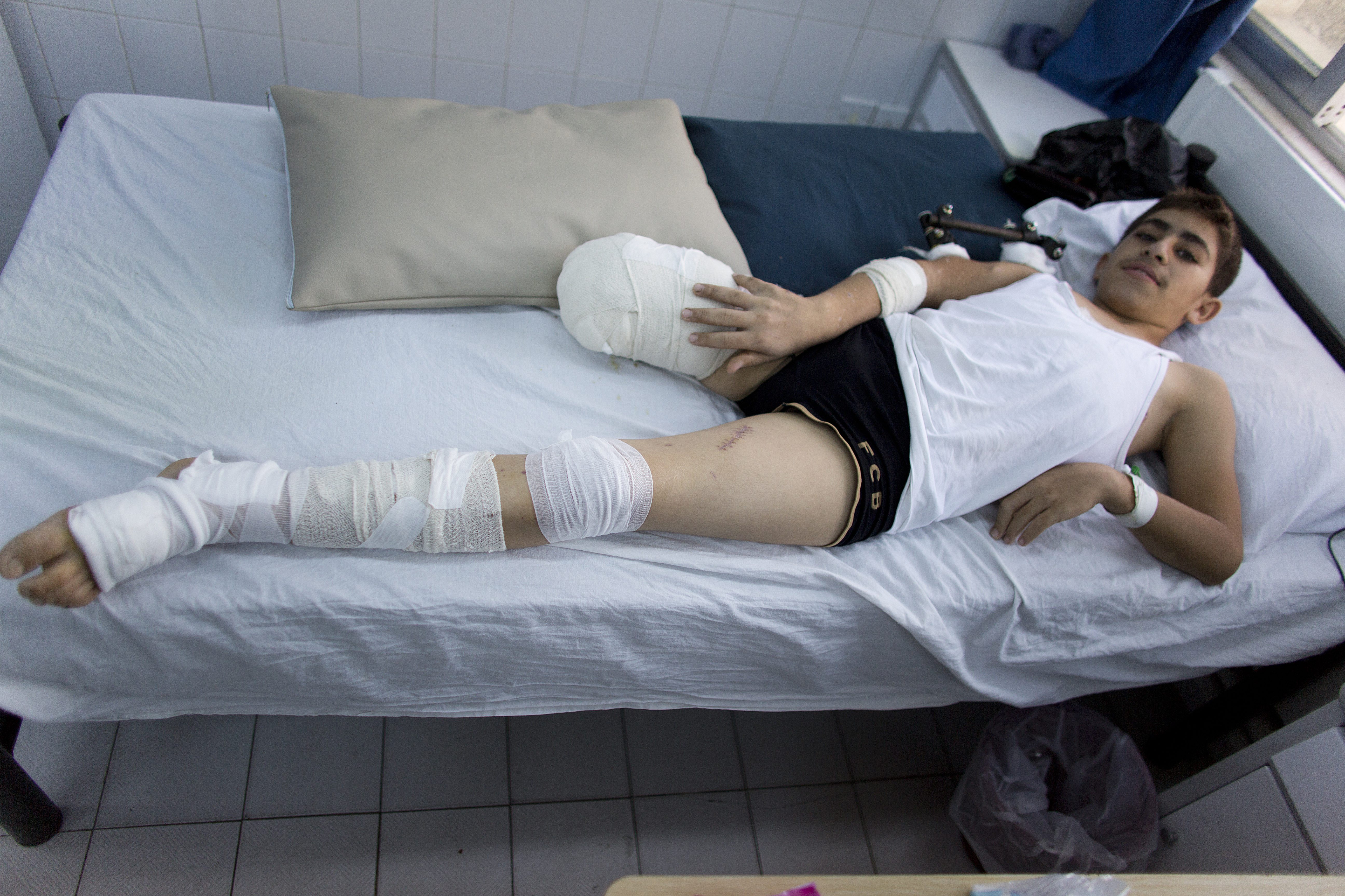 Marked for a lifetime : Syrian refugee in a hospital run by Medecins sans Frontieres in Jordan.